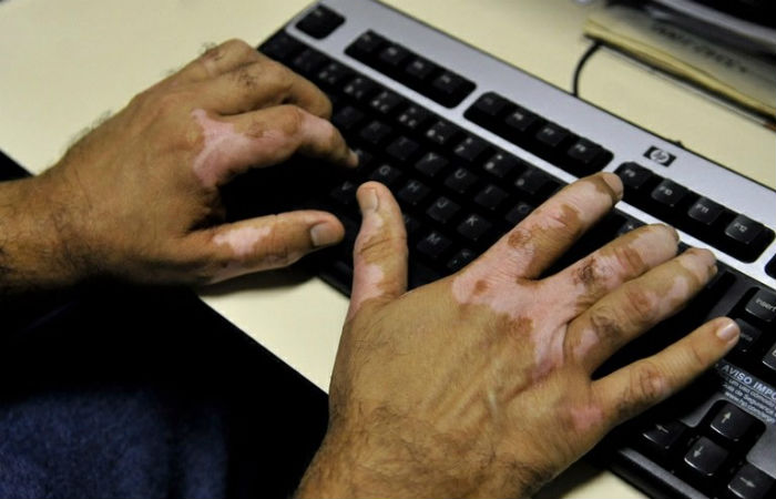 Dia Mundial do Vitiligo, 25 de junho, ressalta a importância sobre a humanização da doença