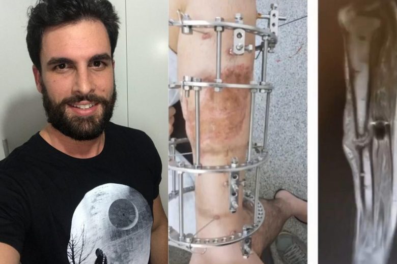 Homem cria vaquinha online para viabilizar cirurgia de urgência na perna