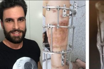 Homem cria vaquinha online para viabilizar cirurgia de urgência na perna