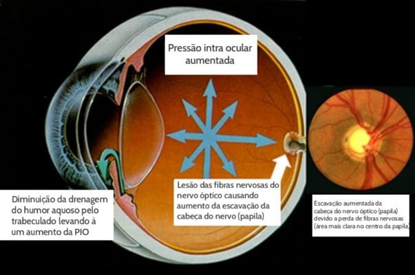 Glaucoma-o-que-e-quais-os-riscos-e-como-prevenir