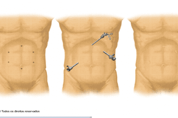 Laparoscopia: O que é? Como é? Quais são as vantagens, desvantagens e os riscos?