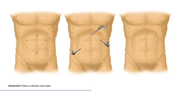 Laparoscopia: O que é? Como é? Quais são as vantagens, desvantagens e os riscos?