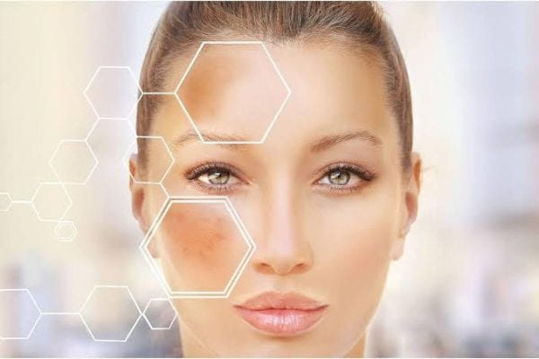 melasma