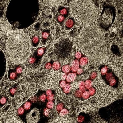 UFMG identifica primeira reinfecção de Covid-19 com nova mutação
