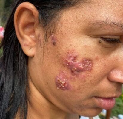 Surto de sarna humana atinge moradores do litoral de São Paulo