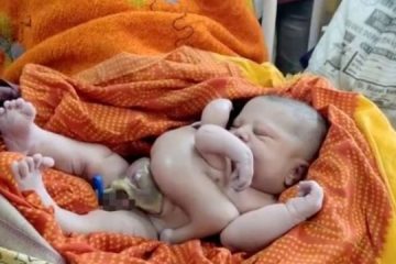 Bebê que nasceu com quatro braços e quatro pernas é endeusado na Índia