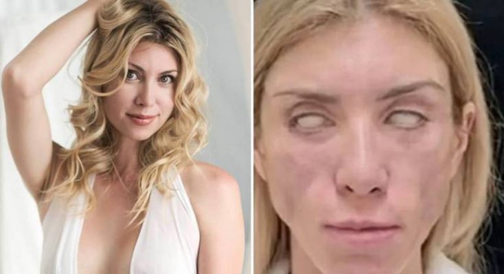 Miss russa fica sem sorrir e sem fechar os olhos após plásticas