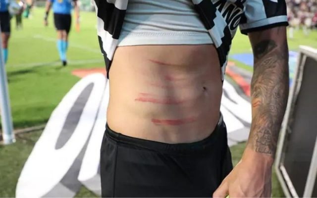 Lateral atleticano mostra marcas depois de falta violenta contra o Goiás