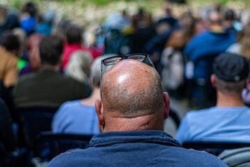 Saiba mais sobre alopecia androgenética masculina