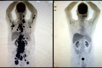 Entenda como funciona a terapia celular CAR-T Cell contra o câncer