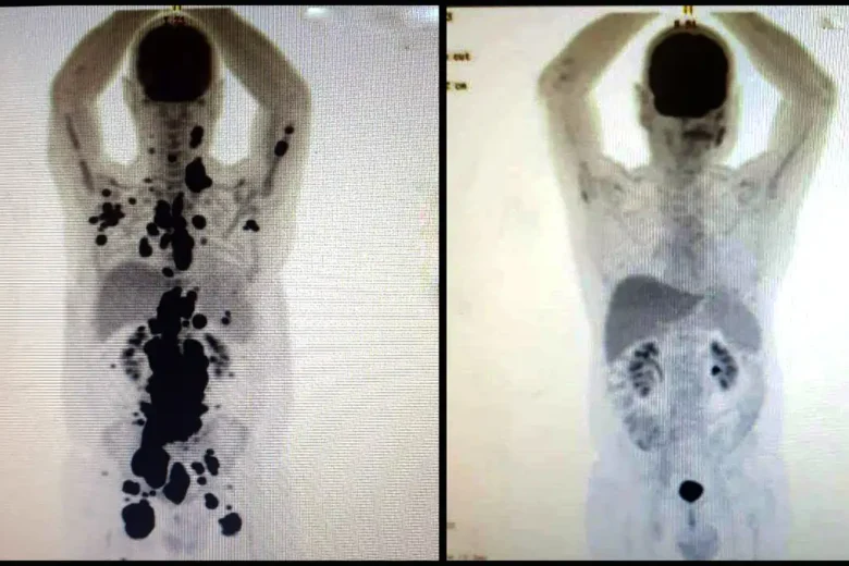 Entenda como funciona a terapia celular CAR-T Cell contra o câncer