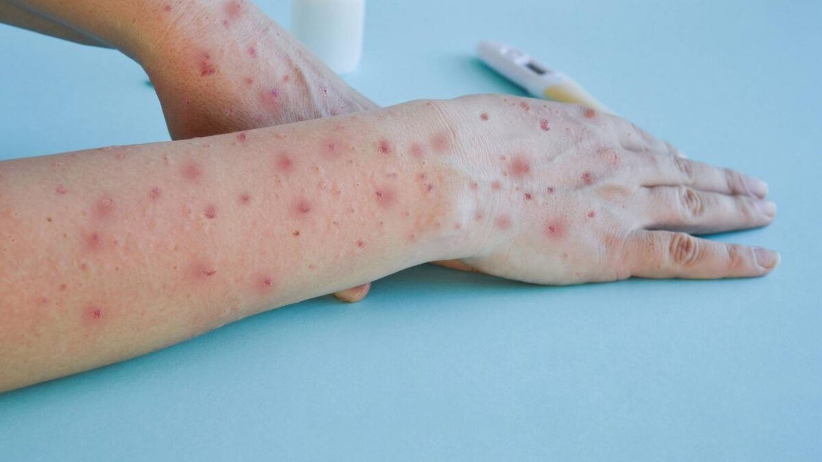 Mpox: fabricante de vacina pede autorização para imunizar adolescentes
