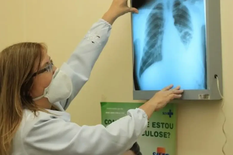 Brasil corre risco de aumento da tuberculose e não deve cumprir meta da OMS