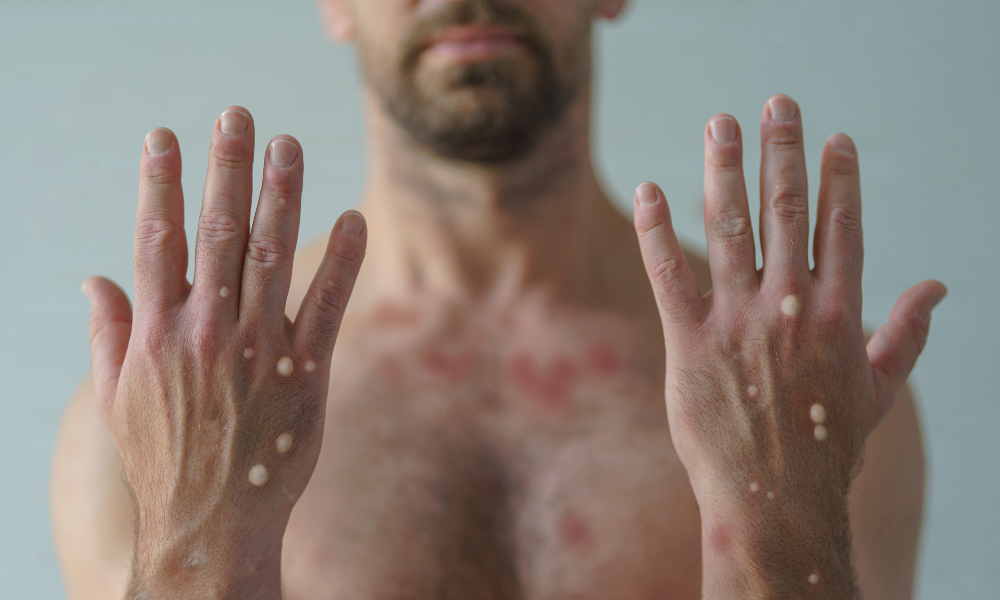 Saúde confirma 1º caso de nova cepa de mpox no Brasil