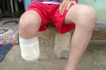 Homem é condenado após amputar o pé para receber seguro de R$ 1,5 milhão