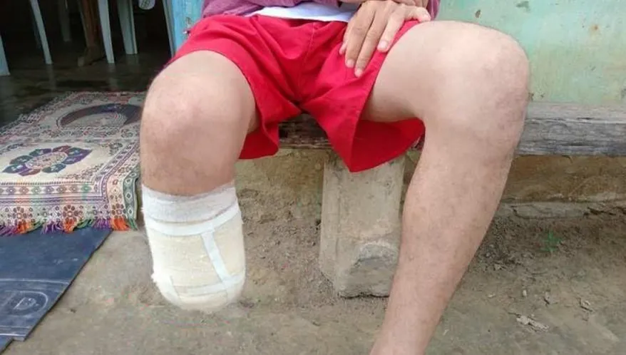 Homem é condenado após amputar o pé para receber seguro de R$ 1,5 milhão