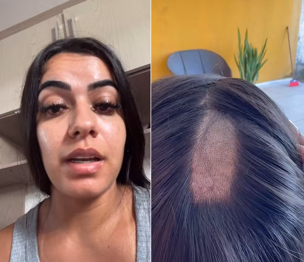 Clínica raspa cabelo de mulher em exame toxicológico para CNH