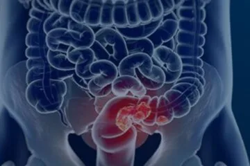 Câncer de intestino dá primeiros sinais no banheiro: veja hábitos de risco e como diagnosticar