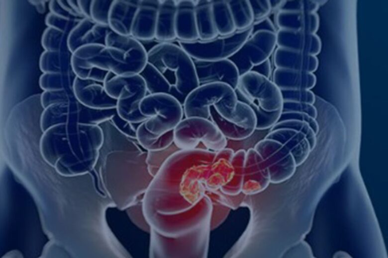 Câncer de intestino dá primeiros sinais no banheiro: veja hábitos de risco e como diagnosticar