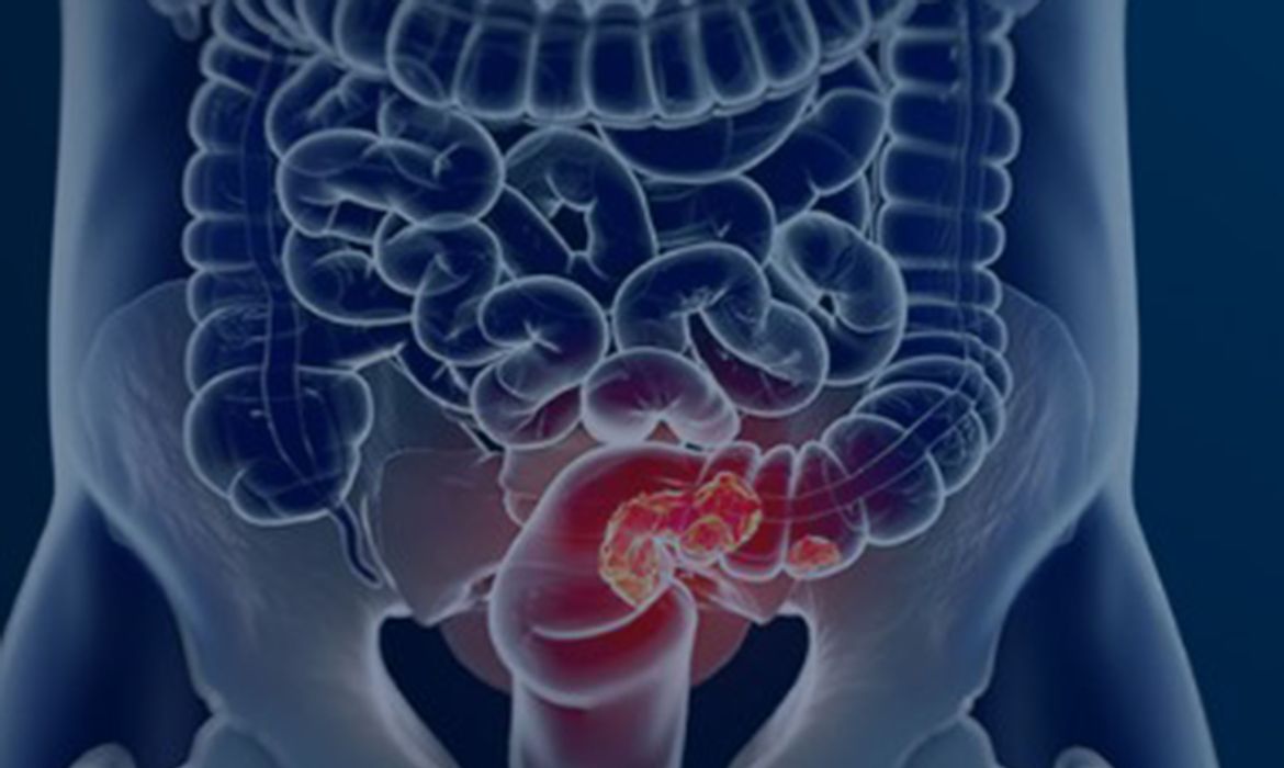 Câncer de intestino dá primeiros sinais no banheiro: veja hábitos de risco e como diagnosticar