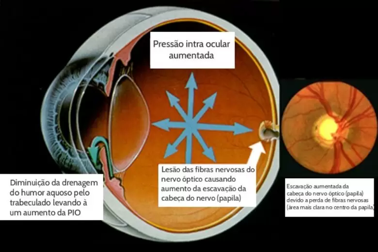 Glaucoma: o que é, quais os riscos e como prevenir? Glaucoma: o que é, quais os riscos e como prevenir?