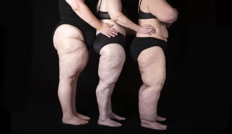 Você sabe o que é lipedema? Conheça os sinais da doença que está presente em 10% das mulheres Você sabe o que é lipedema? Conheça os sinais da doença que está presente em 10% das mulheres