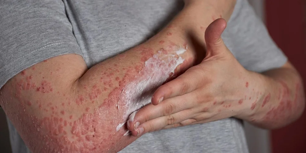 Projeto que prevê vacina de herpes-zoster no SUS está parado há um ano na Câmara dos Deputados Projeto que prevê vacina de herpes-zoster no SUS está parado há um ano na Câmara dos Deputados